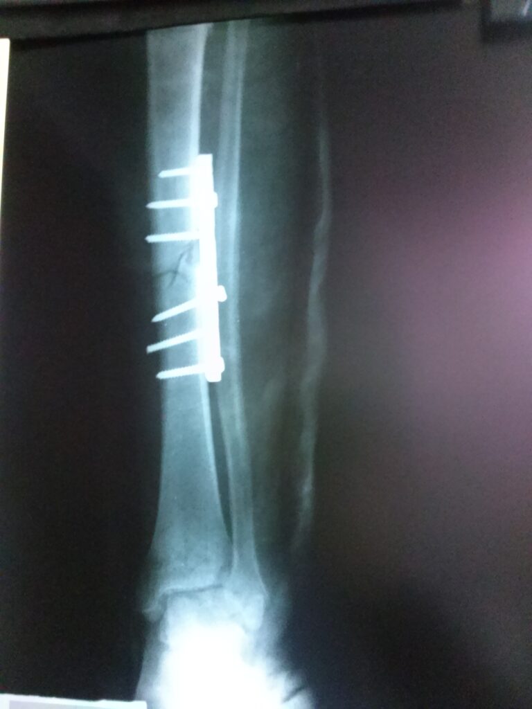 PROVEEDORES DE MATERIAL DE OSTEOSÍNTESIS EN MÉXICO